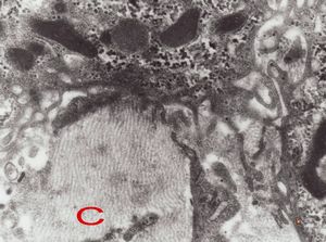 F,7m. | giant cell hepatitis-C-collagen fibers F,7m. | giant cell hepatitis-C-collagen fibers